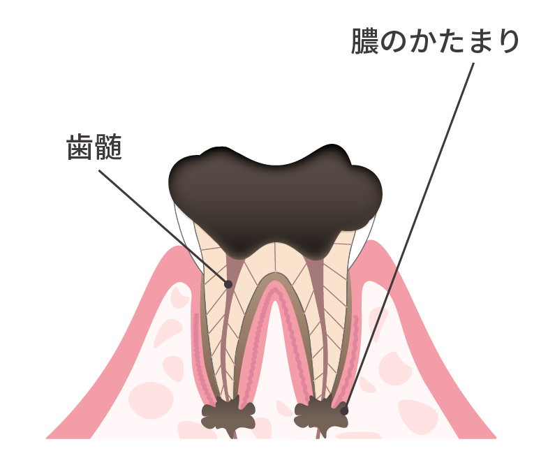 歯根に達した虫歯 断面図