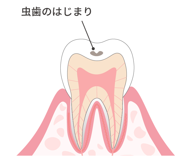 虫歯のはじまり 上面図