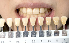 シェードガイドと実際の歯を比較しています