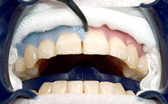 歯茎の保護を行います