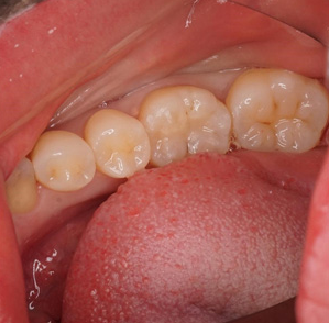 奥歯の虫歯の治療治療後