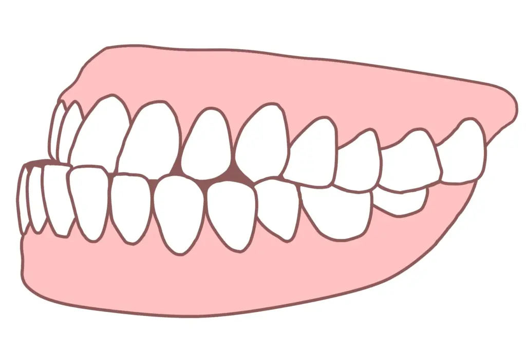 受け口（反対咬合）