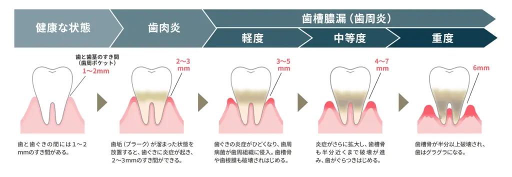 歯周病の進行と段階別治療法